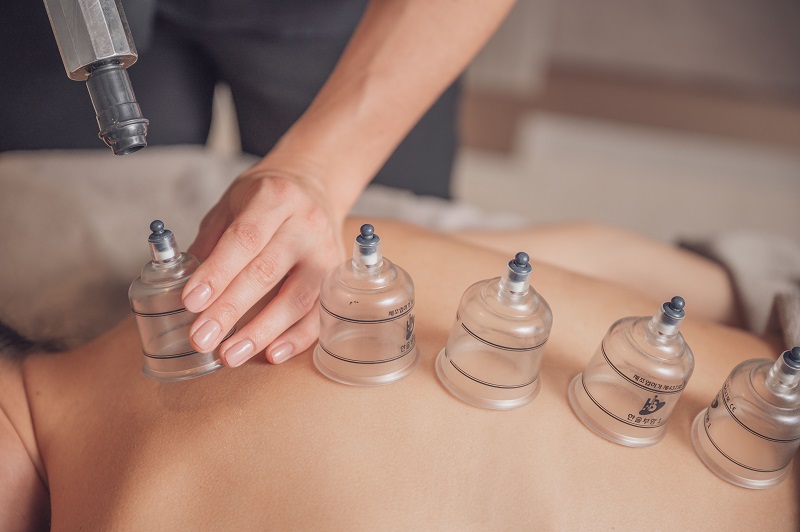 cupping therapy treatment Stirling, Scotland
